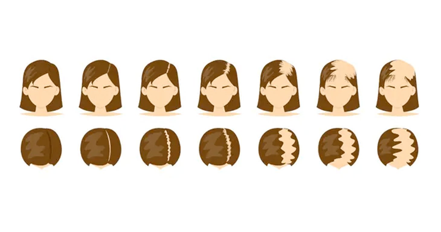 Diagram of the Ludwig scale displaying various stages of female hair thinning and pattern baldness, used for assessing scalp micropigmentation treatments.