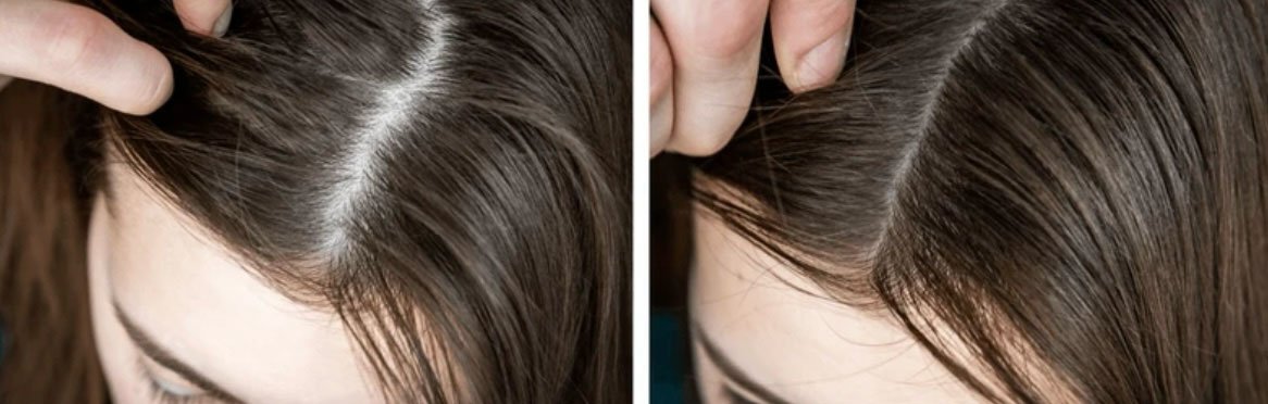 Before and after comparison of a woman’s hairline showing increased density after hair regrowth treatment