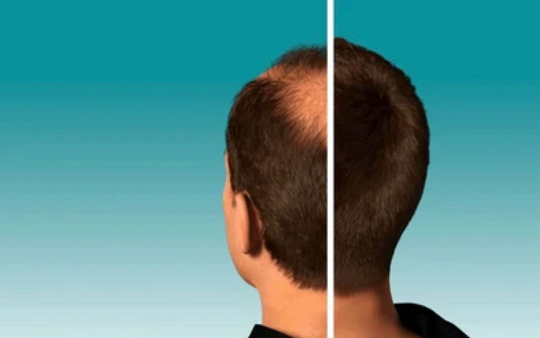 Side-by-side comparison of a man’s balding crown before and after a hair restoration treatment.