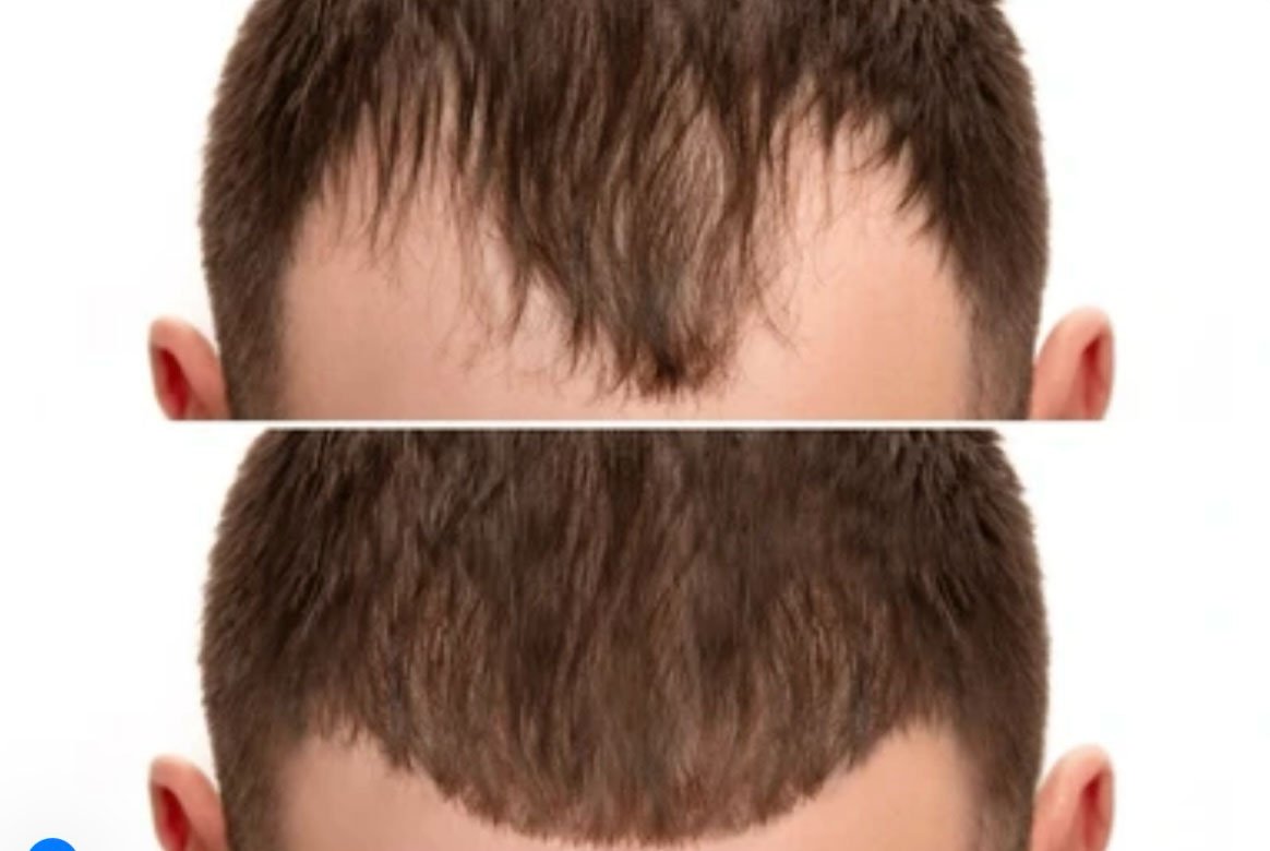 Before and after close-up of a man’s receding hairline, showing significant hair restoration results.