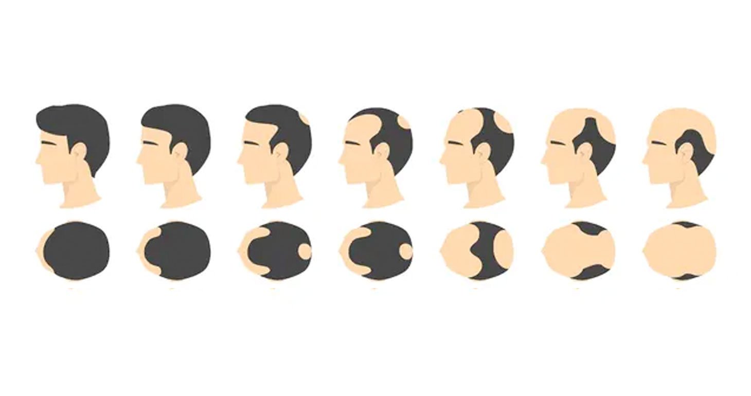 Illustration of the Norwood scale showing different stages of male pattern baldness, used to determine scalp micropigmentation pricing and treatment plans.