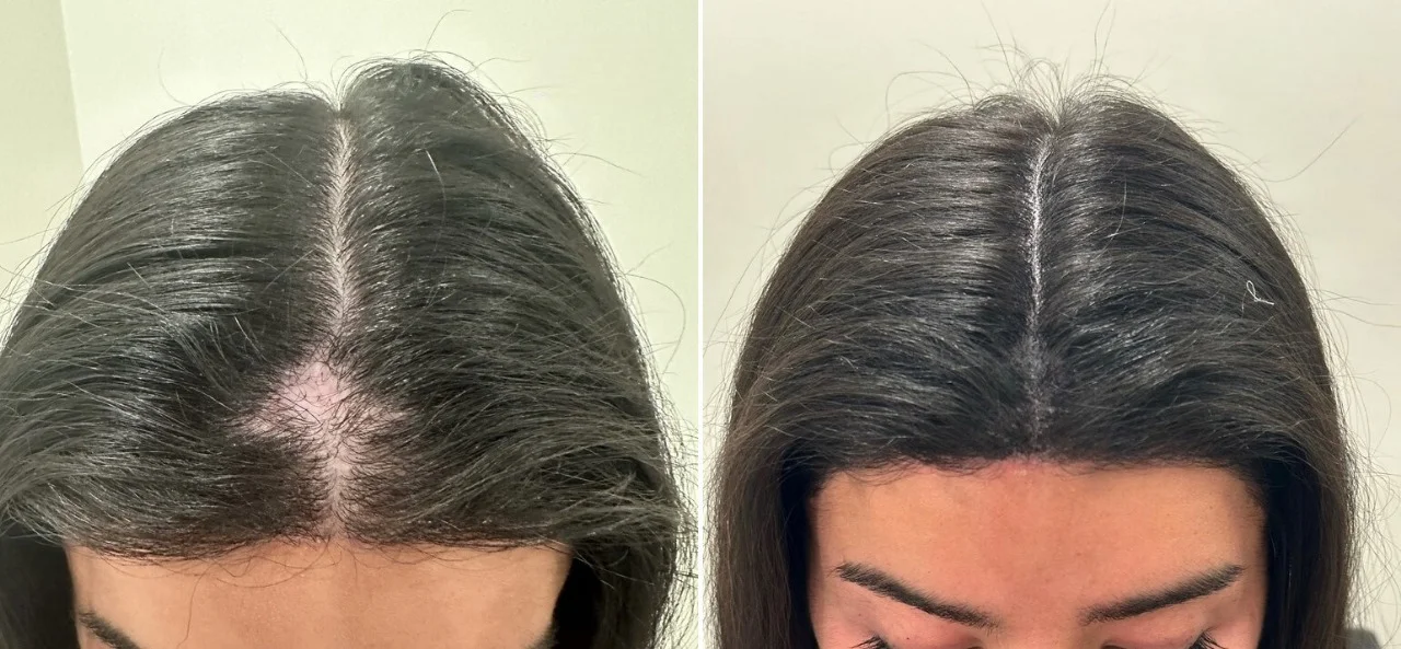 Before and after results of scalp micropigmentation for a woman with thinning hair along the hair part, showing increased density and a fuller appearance.