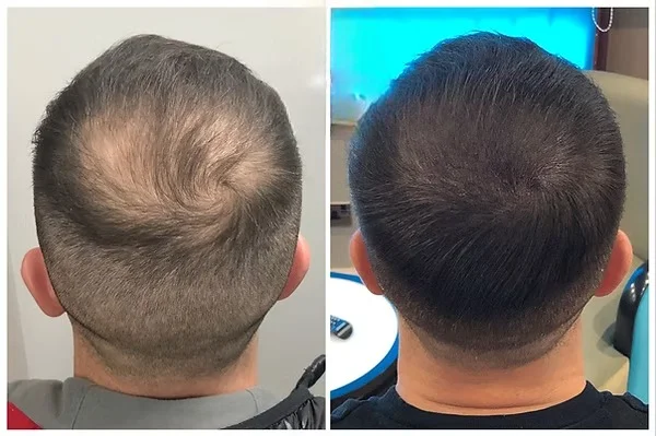 Before and after results of scalp micropigmentation for a man with crown baldness, showing a restored hairline and natural-looking density.