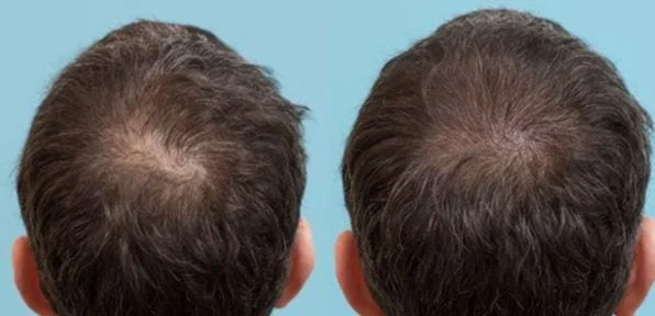 Before and after results of scalp micropigmentation for a man with thinning hair, demonstrating a subtle and natural enhancement in scalp coverage.