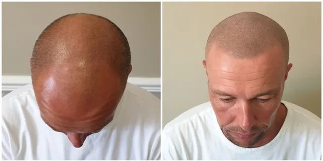 Before and after transformation of a bald man receiving scalp micropigmentation, replicating the appearance of a closely shaved head with natural-looking follicles.