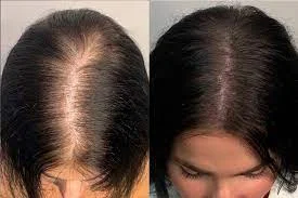 Before and after images of scalp micropigmentation for a woman with a widening hair part, showing a restored and fuller hairline.