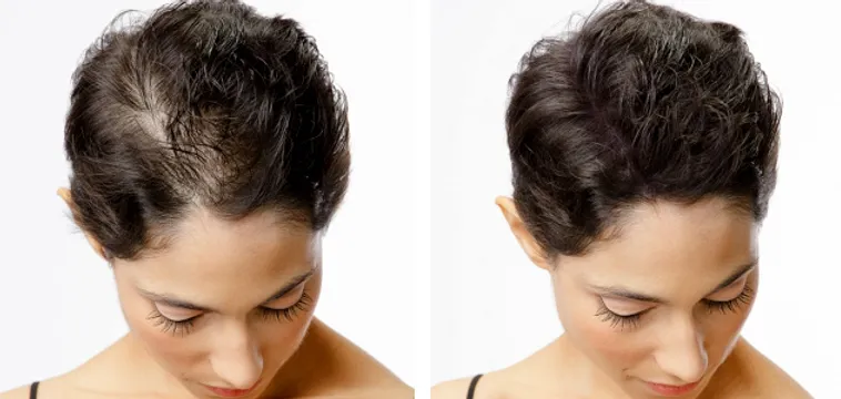 Before and after images of a woman with short hair undergoing scalp micropigmentation, showing improved scalp coverage and enhanced density.