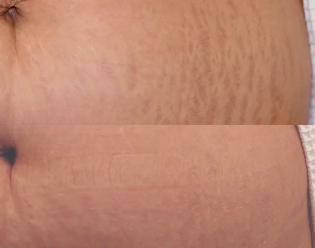 Before and after images of stretch mark camouflage tattooing on the stomach, showing a significant reduction in visibility.