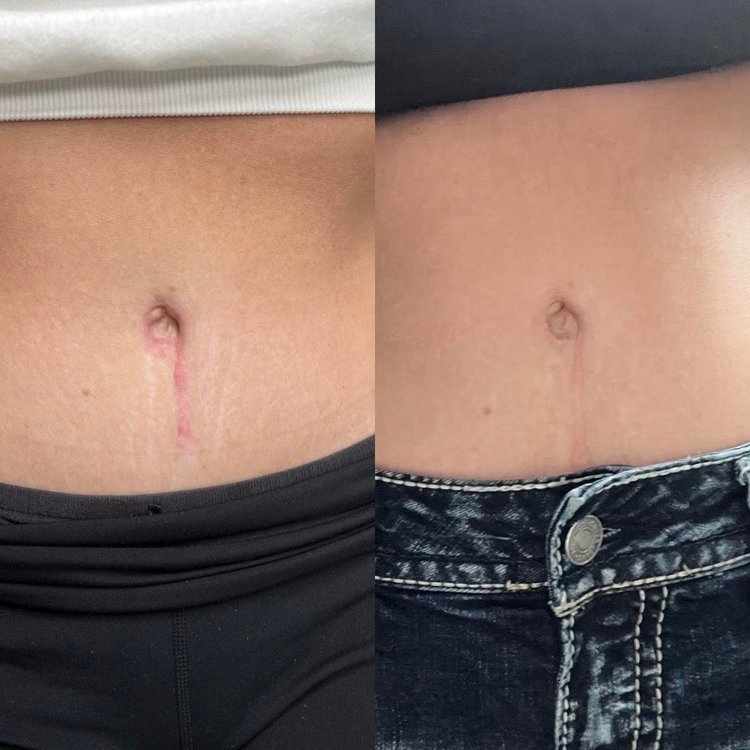 Belly button scar revision with stem cells, 5 sessions improving tone, texture, and stretch marks.