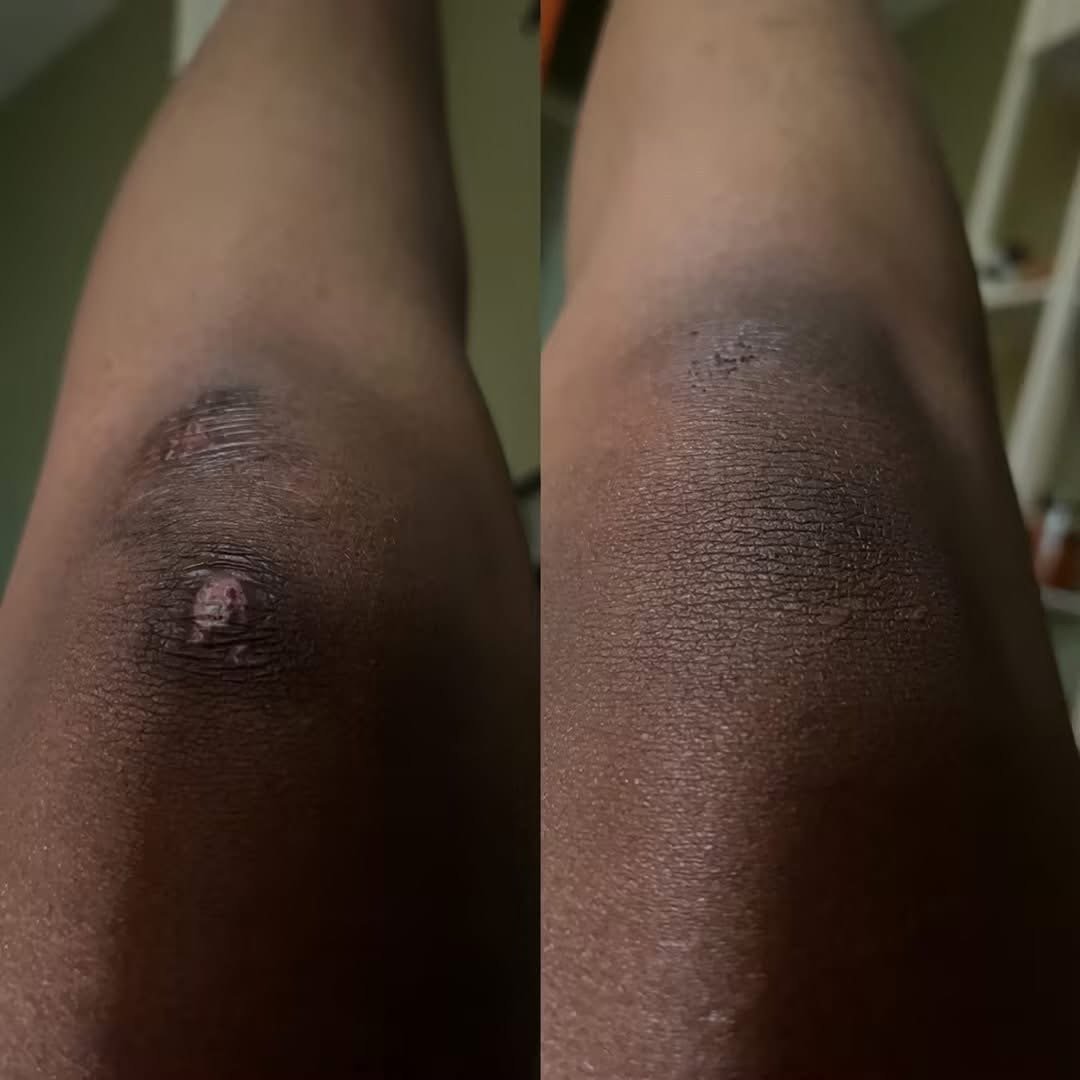 Knee scar camouflage with custom pigment blend, 2 sessions to match natural skin tone.