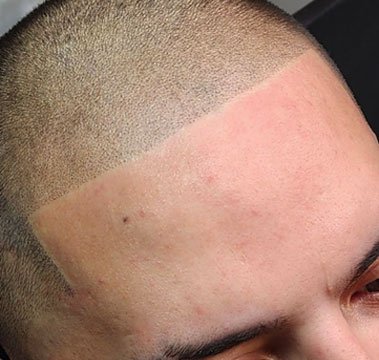 Front view of freshly completed scalp micropigmentation showing natural, defined hairline and even color blend.