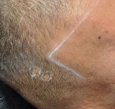 Close-up of scalp showing hairline design marked with white pencil before scalp micropigmentation treatment.