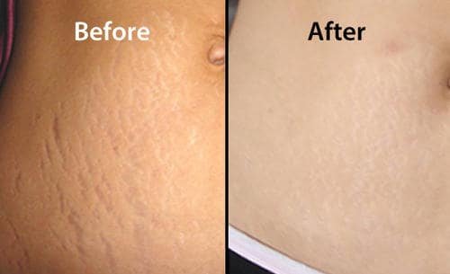 abdominal-scar-treatment-before-after Before and after comparison of abdominal scar appearance showing smoother skin texture after cosmetic treatment