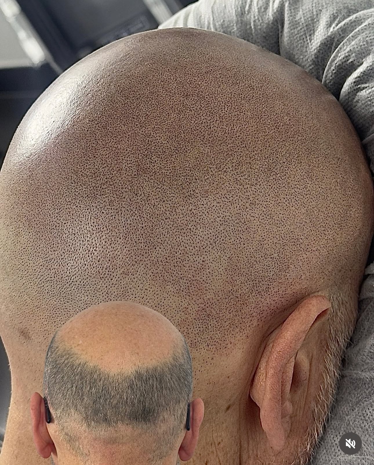 scalp-micropigmentation-before-after-shaved-head Scalp micropigmentation before and after results on shaved head showing natural hair follicle appearance