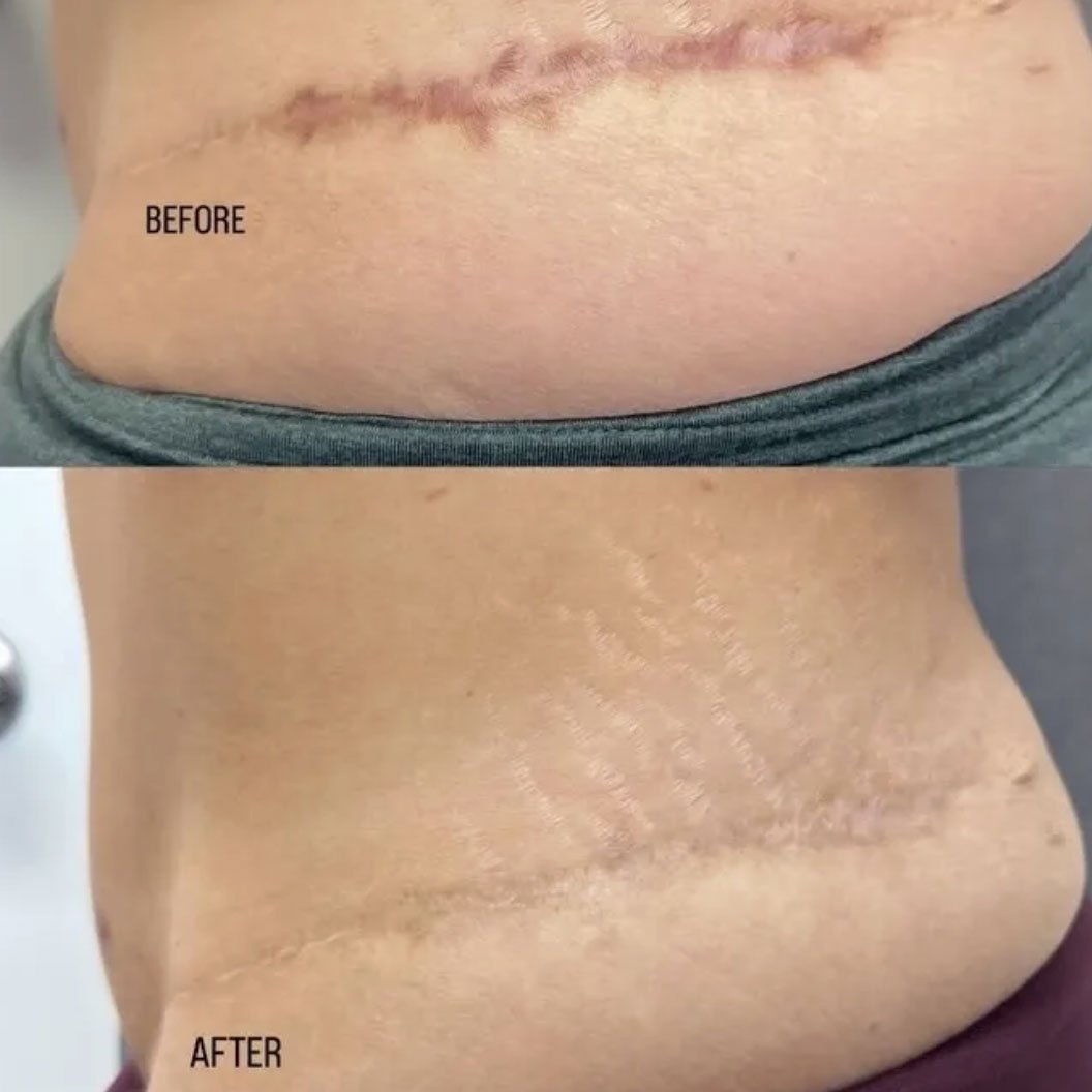 stretch-marks-treatment-before-after Before and after comparison of stretch marks showing improved skin tone and texture after treatment