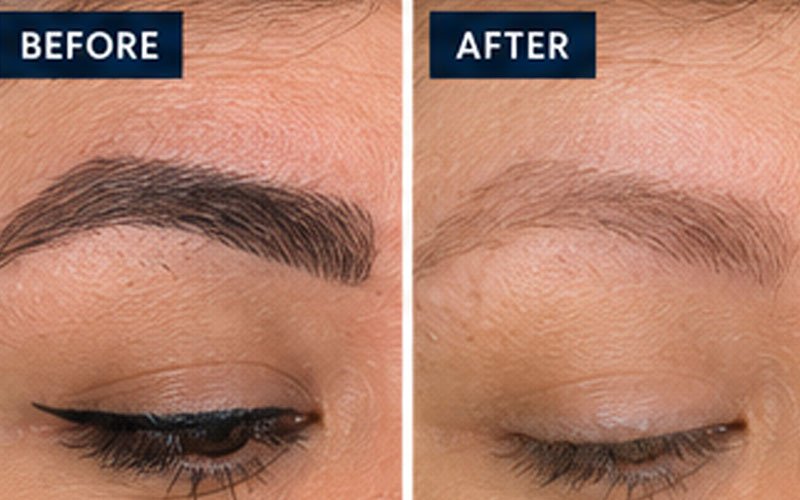 Laser-tattoo-removal-eyebrows
