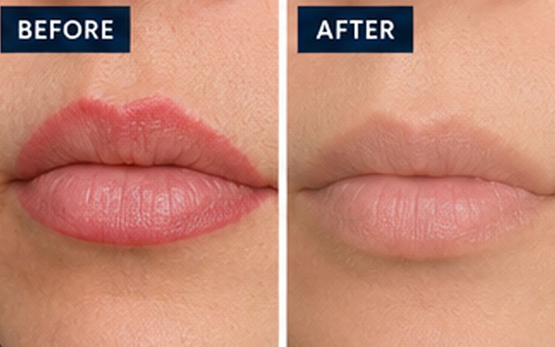 Laser-tattoo-removal-lips
