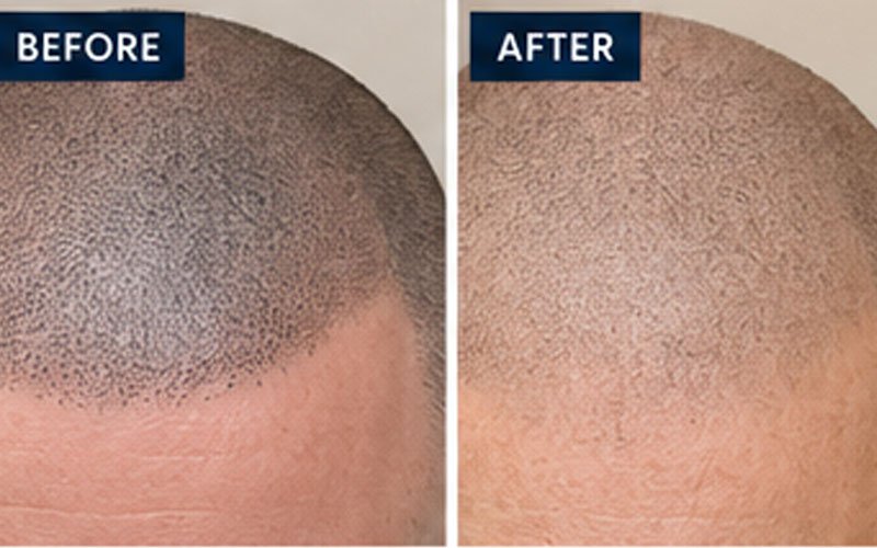 Laser-tattoo-removal-smp